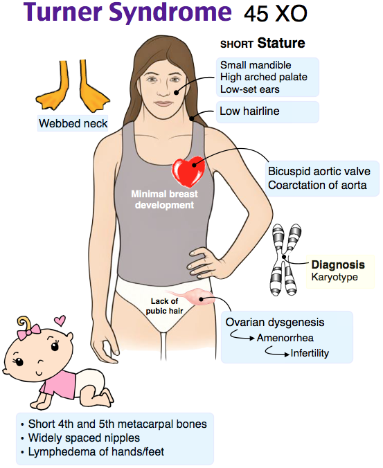 Zoology Notes On – Turner Syndrome – For W.B.C.S. Examination.