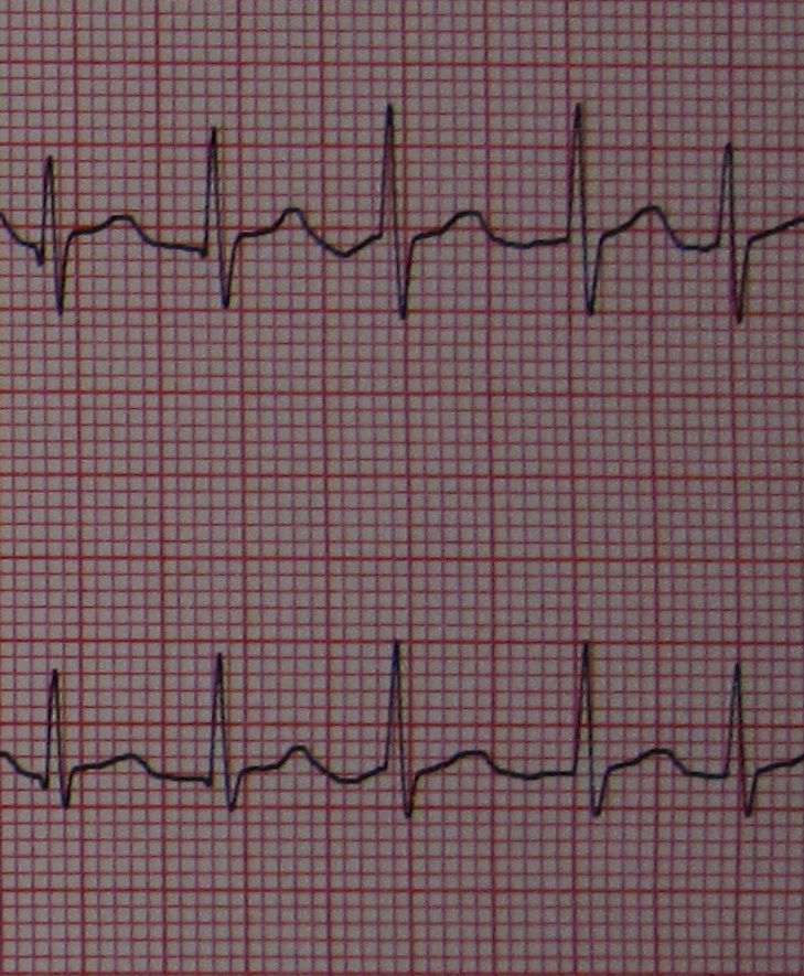 Causes Of Atrial Fibrillation  – Medical Science Notes – For W.B.C.S. Examination.