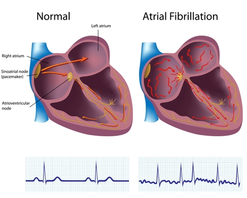 Medical Science Notes – On – Atrial Fibrillation – For W.B.C.S. Examination.