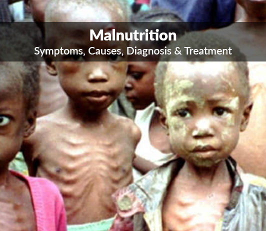 Essay Composition On – Malnutrition – For W.B.C.S. Examination.