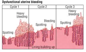 W.B.C.S. Examination Notes On – Dysfunctional Uterine Bleeding – Medical Science Notes.