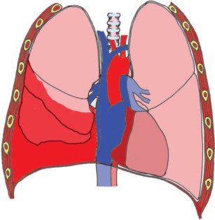 Medical Science Notes On – Haemothorax – For W.B.C.S. Examination.