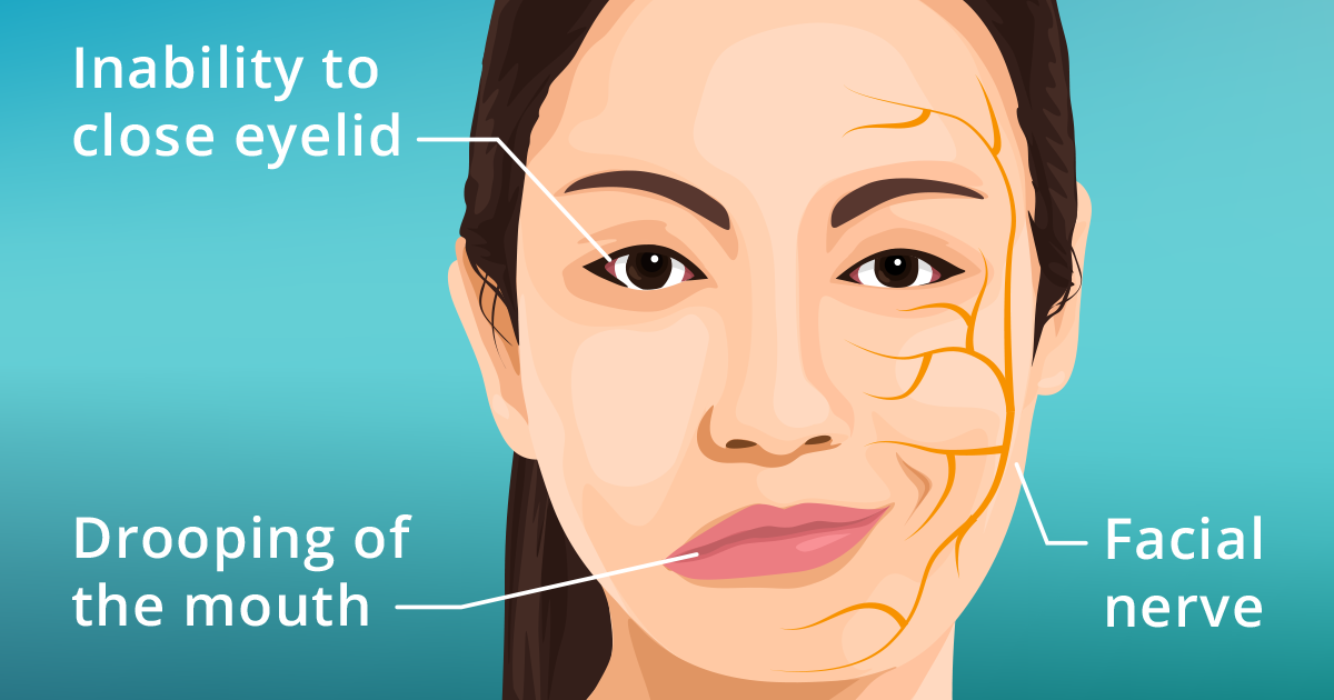 W.B.C.S. Examination Notes On – Bell’s Palsy – Medical Science Notes.