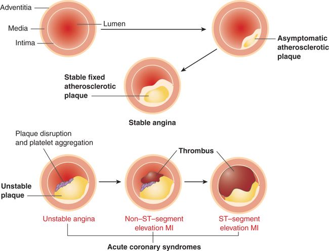 W.B.C.S. Main 2018 Question Answer – Medical Science – Unstable Angina.