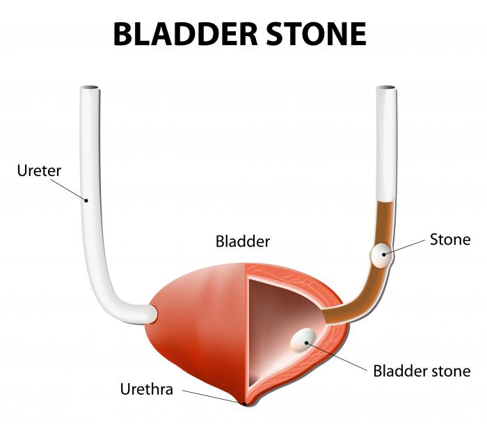 Medical Science Notes On – Bladder Stones – For W.B.C.S. Examination.