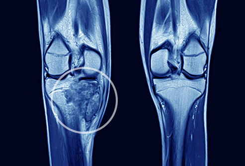 W.B.C.S. Examination Notes On – Bone Tumor – Medical Science Notes.